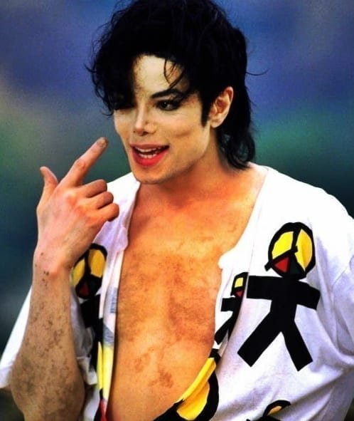 Vitiligo Makeup is the Worst Representation and Way of Support