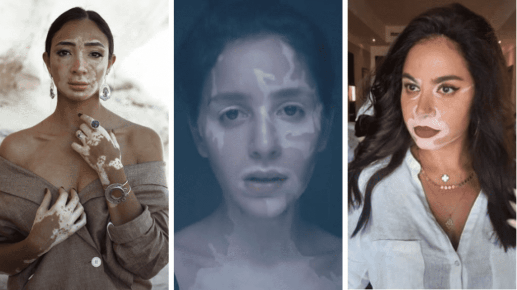 Vitiligo Makeup is the Worst Representation and Way of Support